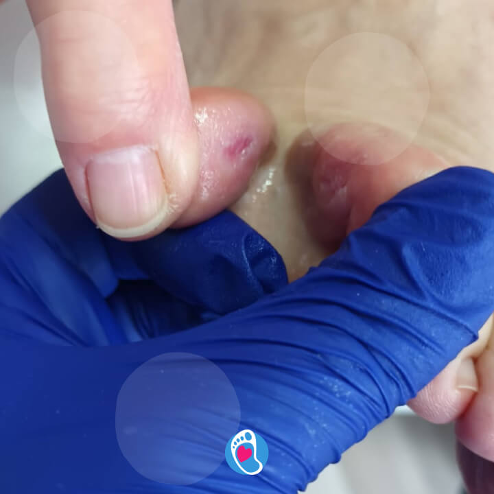 Zdjęcie stopy z grzybicą między palcami, ukazujące potrzebę odpowiedniej wentylacji i luźnego obuwia barefoot Grzybica między palcami – znaczenie wentylacji i odpowiedniego obuwia barefoot | Bosa Stopka