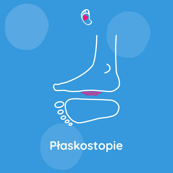 wady-stop-u-dzieci-plaskostopie-Program-pilotazowy-badania-stop-dzieci-i-mlodziezy wady-stop-u-dzieci-plaskostopie-Program-pilotazowy-badania-stop-dzieci-i-mlodziezy