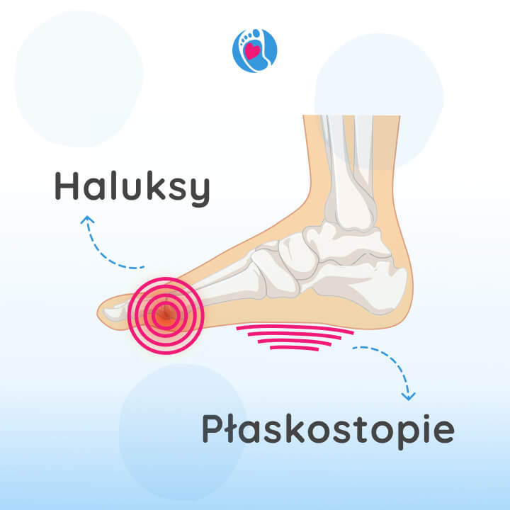 haluksy-plaskostopie-Badania-naukowe-trendy-buty-damskie-meskie-wplyw-na-deformacje-stop-bosa-stopka-sklep-z-butami-barefoot