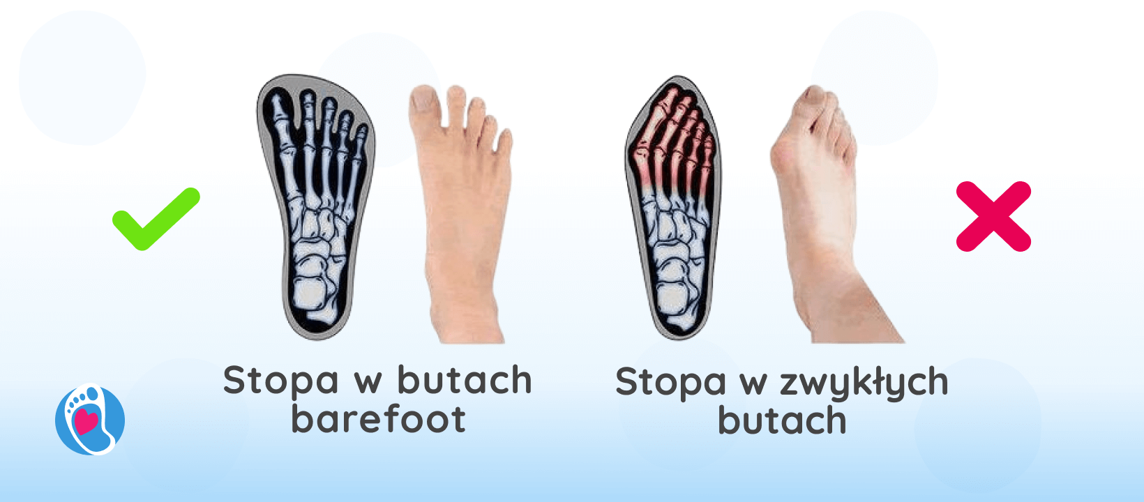 porownanie-stopa-w-butach-barefoot-stopa-w-klasycznych-butach-Badania-naukowe-trendy-buty-damskie-meskie-wplyw-na-deformacje-stop-bosa-stopka-sklep-z-butami-barefoot.