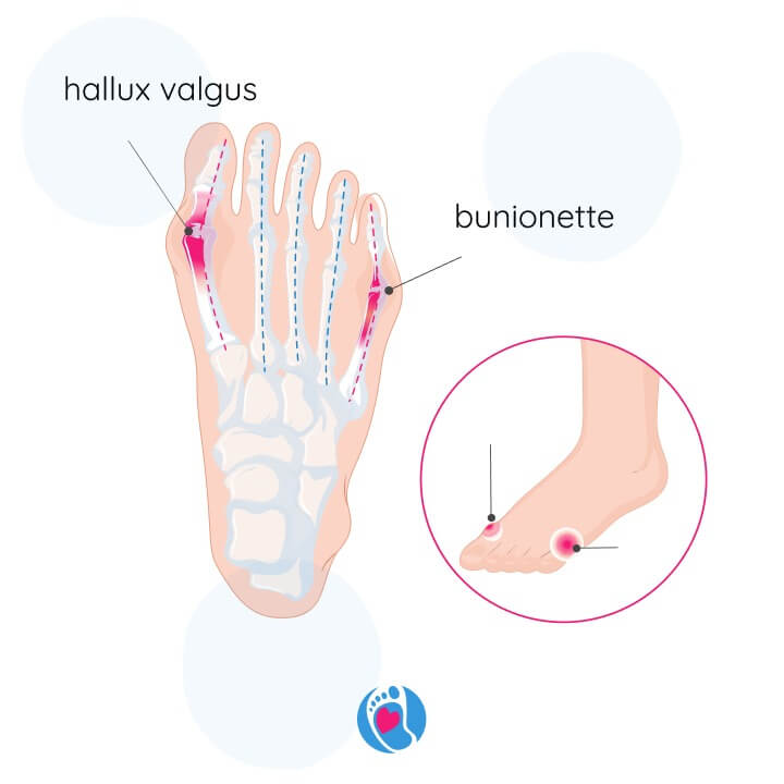 przyczyny-bolu-haluksy-anatomia-stopy-obciazenia-buty-barefoot-Bosa-Stopka Schematyczne przedstawienie bólu przy haluksach – przyczyny i znaczenie anatomiczne w kontekście butów barefoot