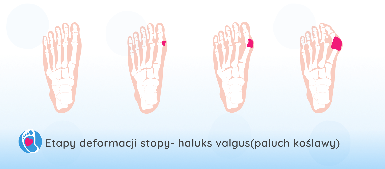 etapy-deformacji-stopy-haluks-buty-barefoot-Bosa-Stopka Ilustracja czterech etapów deformacji stopy przy haluksach – od łagodnej do zaawansowanej, barefoot jako profilaktyka