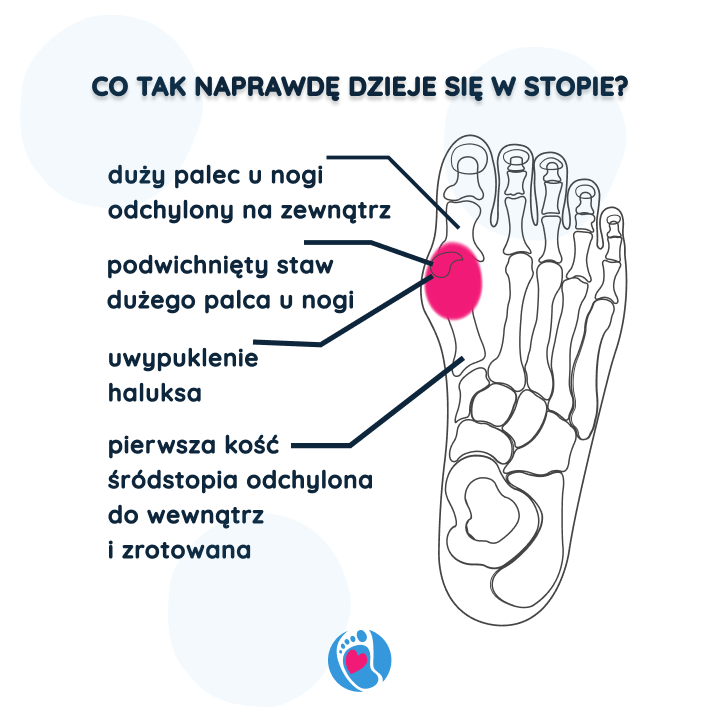 anatomia-haluksa-jak-zmienia-sie-uklad-kosci-w-stopie-z-deformacja Schemat pokazujący deformację przy haluksie – naturalna korekta możliwa dzięki butom barefoot od Bosa Stópka