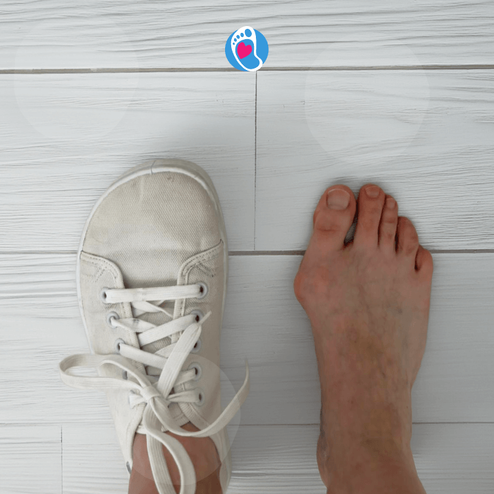 zdeformowana-stopa-haluks-przyczyna-i-efekt-buty-barefoot-Bosa-Stopka Widoczna deformacja stopy z haluksami – obraz poglądowy wspierający dobór zdrowych butów barefoot