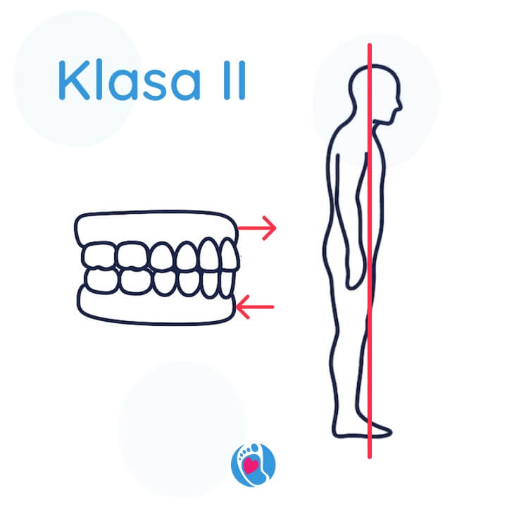 klasa-II-cofniecie-zuchwy-postawa-ciala-buty-barefoot-Bosa-Stopka. Klasa II – cofnięta broda i wypchnięty tułów. Zgryz i postura wymagające korekty. Bosa-Stopka, buty-barefoot