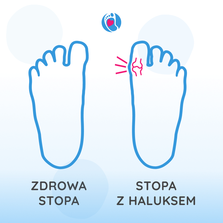 zdrowa-stopa-vs-haluksy-deformacja-palucha-koslawego Porównanie zdrowej stopy i stopy z haluksem. Po lewej stronie widoczna jest prawidłowo ukształtowana stopa, a po prawej stopa z deformacją palucha koślawego zaznaczoną czerwonym symbolem bólu