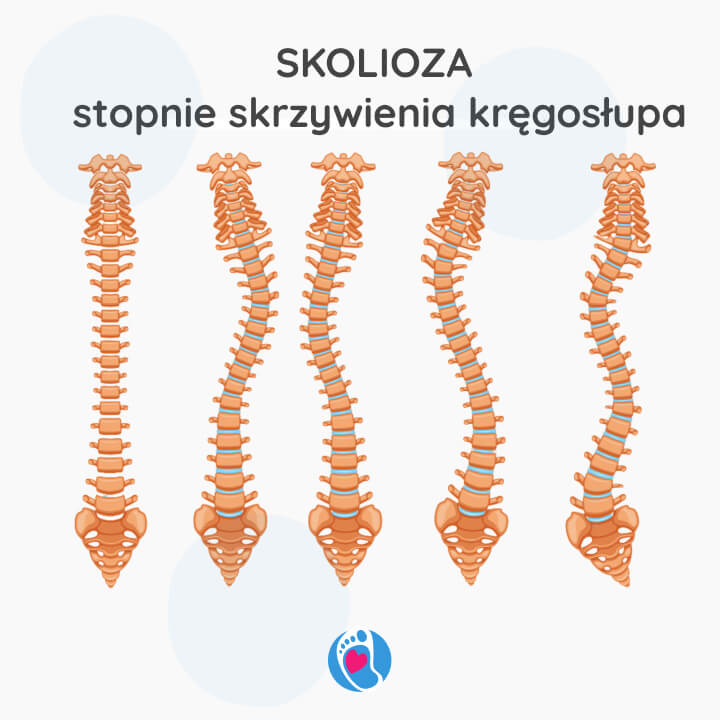 skolioza-wplyw-na-kregoslup-czlowieka-to-jego-rusztowanie-bosa-stopka-sklep-blog-okiem-fizjoterapeuty