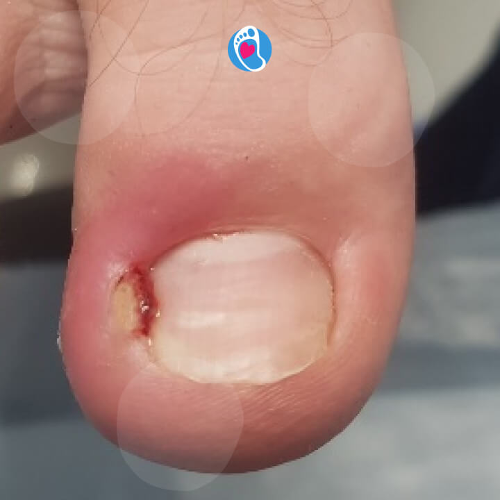 stany-zapalne-plytka-paznokciowa-okiem-eksperta-podolog-sylwia-purzynska-bosa-stopka-sklep-buty-barefoot stany-zapalne-plytka-paznokciowa-okiem-eksperta-podolog-sylwia-purzynska-bosa-stopka-sklep-buty-barefoot