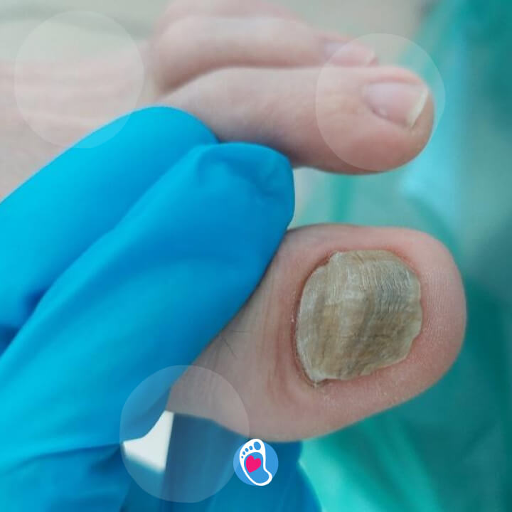 uszkodzona-plytka-paznokciowa-okiem-eksperta-podolog-sylwia-purzynska-bosa-stopka-sklep-buty-barefoot uszkodzona-plytka-paznokciowa-okiem-eksperta-podolog-sylwia-purzynska-bosa-stopka-sklep-buty-barefoot