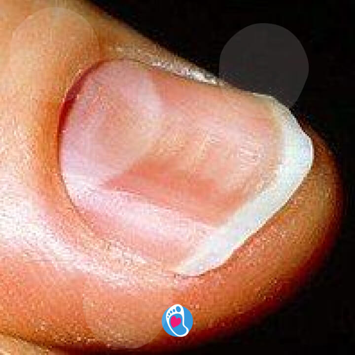 uszkodzona-plytka-paznokciowa-okiem-eksperta-podolog-sylwia-purzynska-bosa-stopka-sklep-buty-barefoot uszkodzona-plytka-paznokciowa-okiem-eksperta-podolog-sylwia-purzynska-bosa-stopka-sklep-buty-barefoot