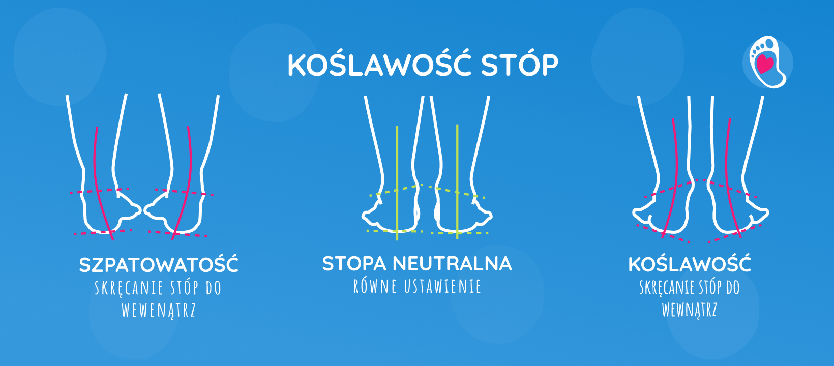 koślawość-stop-dzieciecych-okiem-eksperta-fizjoterapeuta-weronika-siewiera-diagnostyka-stop